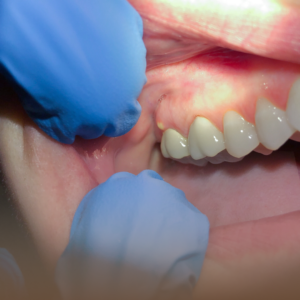 Endodontia Facilitada - Clínica Especializada em Tratamento de Canal em São Bernardo do Campo 6 Dentista examinando um paciente para avaliar possíveis complicações de um canal dentário infectado.